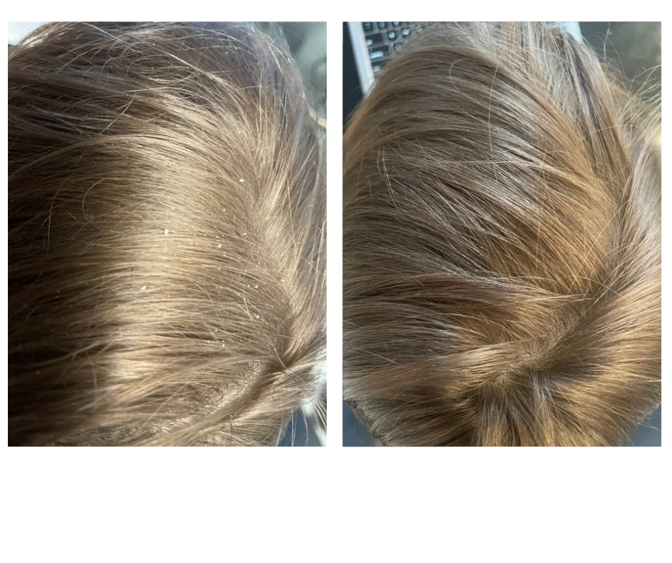 Les pellicules sur les cheveux — causes et solutions naturelles BIOPHYTUM