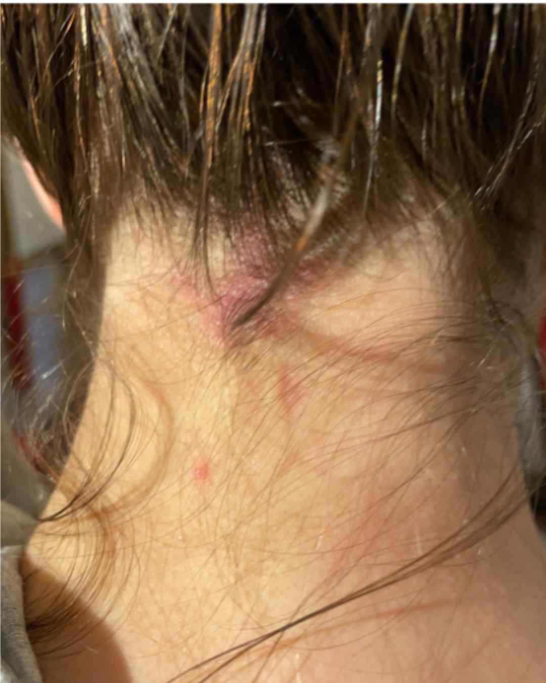 Psoriasis du cuir chevelu - plaques et soins naturels dermo-botaniques BIOPHYTUM